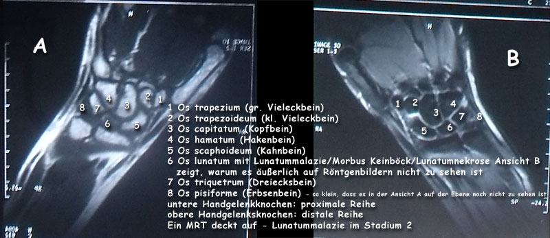 Ueberblick der Fachworte zur deutschen Uebersetzung aller Handwurzelknochen anhand eines MRTs - gespiegelt fuer beide Sichtweisen rechte und linke Hand.